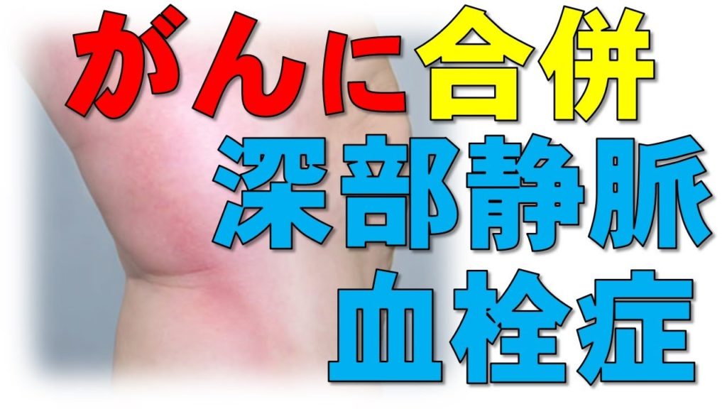 手術後の血栓を防ぐには何が役立ちますか?